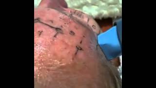 Laser thermage CPT skin tightening before after Sydney Australia specialists