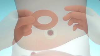 Защитное кольцо Brava моделируемое 2мм, арт 12030, Coloplast