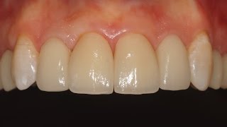Керамические виниры Emax. Porcelain veneers. Carillas Dentales. 牙齿镶