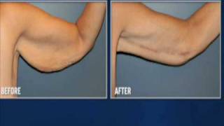 plastic surgery after weight loss