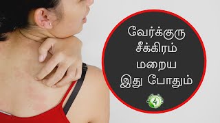 வியர்க்குரு சீக்கிரம் மறைய இதை செய்தால் போதும் |  verkuru remedies in tamil
