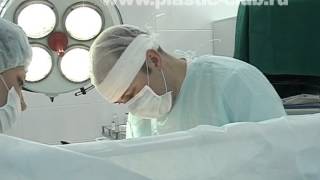 Пластика живота: абдоминопластика и липосакция