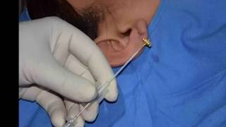 Earlobe piercing using Insulin Syringe & Intravenous Cannula