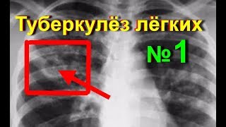 Туберкулез легких. Лечение туберкулеза народными средствами в домашних условиях - № 1