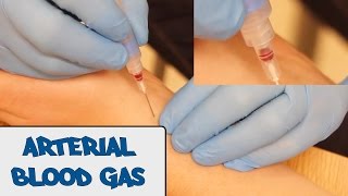 Arterial Blood Gas Sampling (ABG) - OSCE Guide