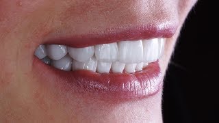 Керамические виниры без препарирования. Люминиры. Emax. Non prep veneers