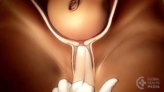 The Vaginal Exam in Labor (Swahili) - Childbirth Series