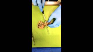 Partial penectomy cut up