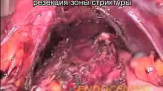 Резекция пищевода при пептической стриктуре