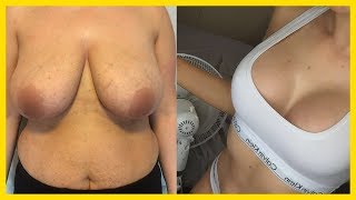 уменьшение груди