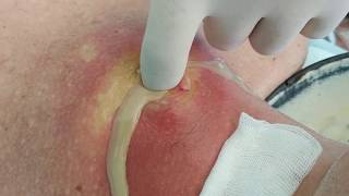 Море гноя!!! Медиастинит,прыщ,фурункул,абсцесс!!!Sea of ​​pus !!! Mediastinitis, pimple, abscess !!!