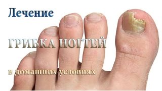 Как лечить грибок ногтей в домашних условиях (натуральные, народные методы лечения)