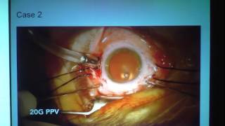 A. Ebneter (Switzerland) The macular hole challenge