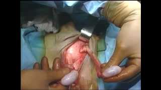 Trans-sexual Surgery Baylor College of Medicine