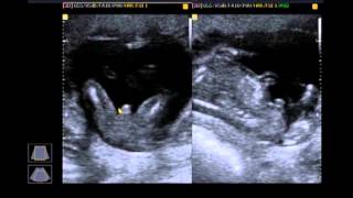 Ultrassom 16 semanas e 4 dias MENINO- Descobrindo MENINO 2º trimestre FINALMENTE!