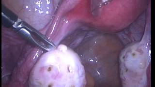 Laparoscopy, Polycystic Ovarian Syndrome, PCOS, PCOD