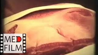 Операция паховой грыжи, академик В.В.Кованов © Inguinal Hernia Operation, Academician V. Kovanov