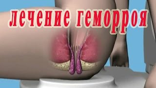 Лечение геморроя в домашних условиях.