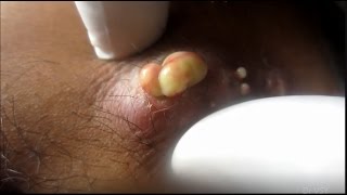 Anterior Abdomen Wall Abscess