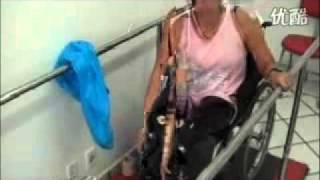 Brazilian DAK-Amputee Exercising with Her New Prosthetic Legs