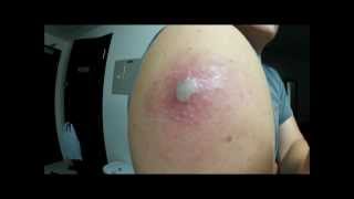 My SmallPox Vaccine Journey