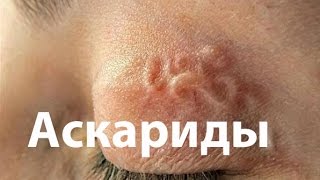 Аскарида