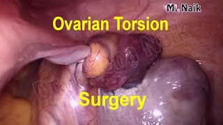 Abdominal hysterectomy with ovarian torsion removal full HD video