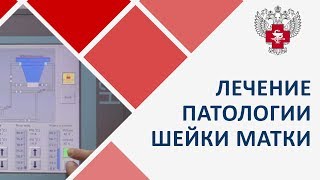 Патология шейки матки. ? Современное малоинвазивное лечение патологии шейки матки. Пироговский Центр