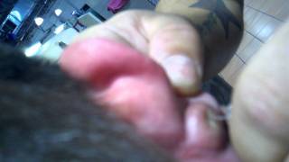 Snowflakes ear testicle - Popping a boil