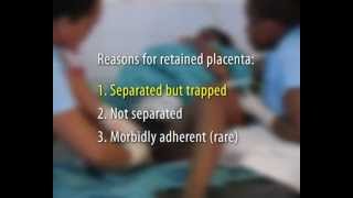 Umbilical vein injection for retained placenta: why and how?