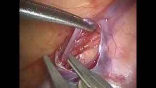 Varicocelectomia Pediatrica