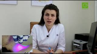 тиреотоксикоз диффузный токсический зоб - ошибки в лечении