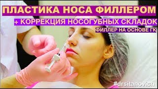 Контурная пластика носа и коррекция носогубных складок. Dr Sitanovich