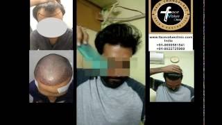 Hair transplant mumbai/ Kolkata/ shimla/ satna/ ahmedabad soon: +91-9699581541; +91-9022725969