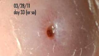 botfly larva in my ankle - days 32-34 update
